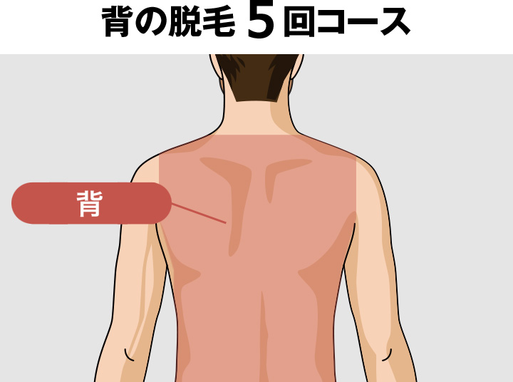 背中の脱毛料金